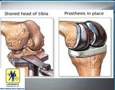 Slider image (4) Dr. Narendra Vaidya | Joint Replacement Specialist